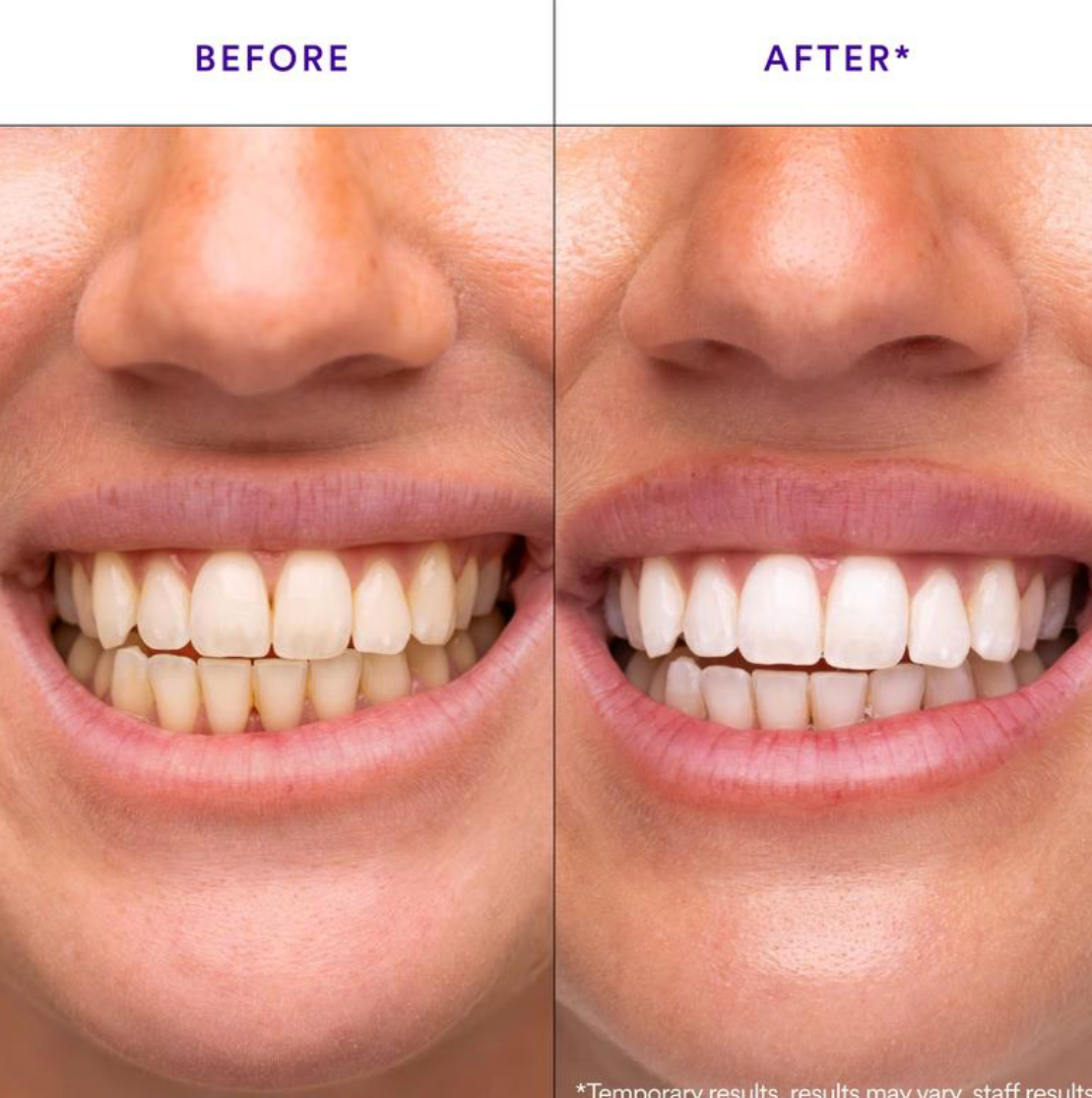 Platinum Wave Whitening Strips