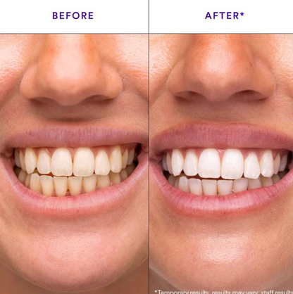 Platinum Wave Whitening Strips